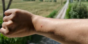 Redback Spider Bite first aid Treatment and Poisons Tips